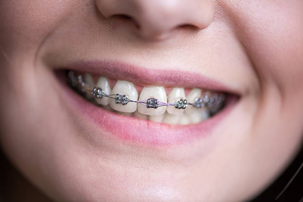 Braces Treatment Options in Middletown