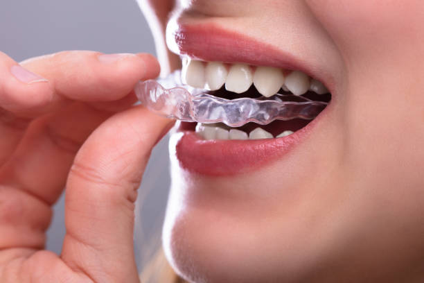 Clear Aligners for Straightening Teeth